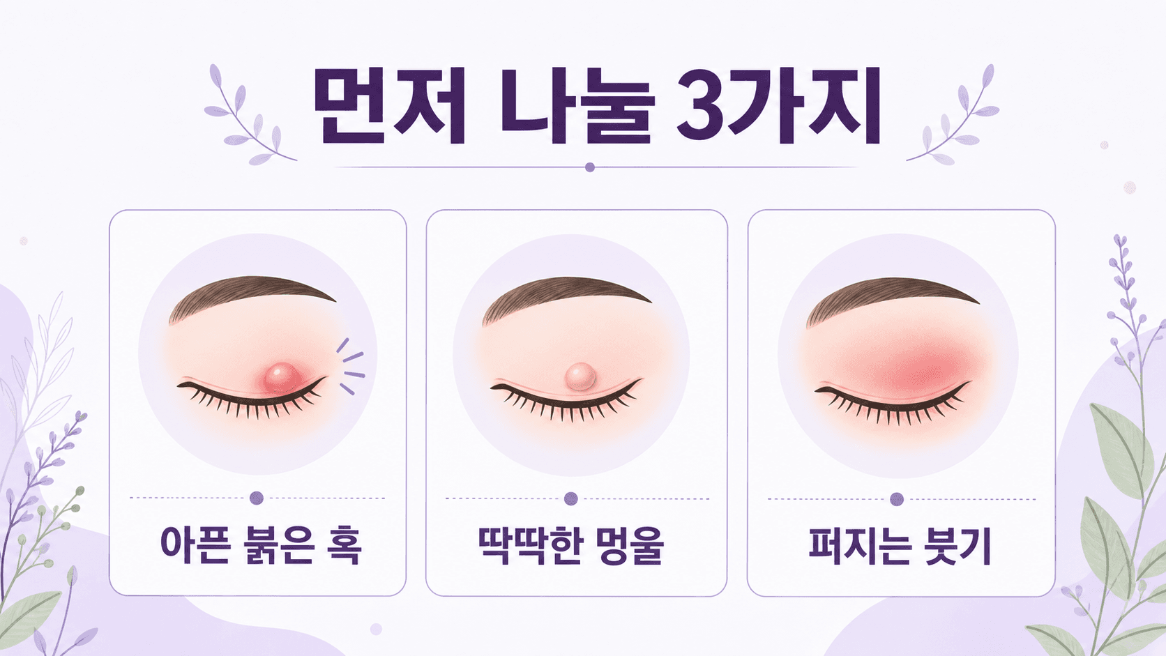 눈꺼풀 다래끼에서 아픈 붉은 혹, 딱딱한 멍울, 퍼지는 붓기를 나누는 3분 기준 이미지