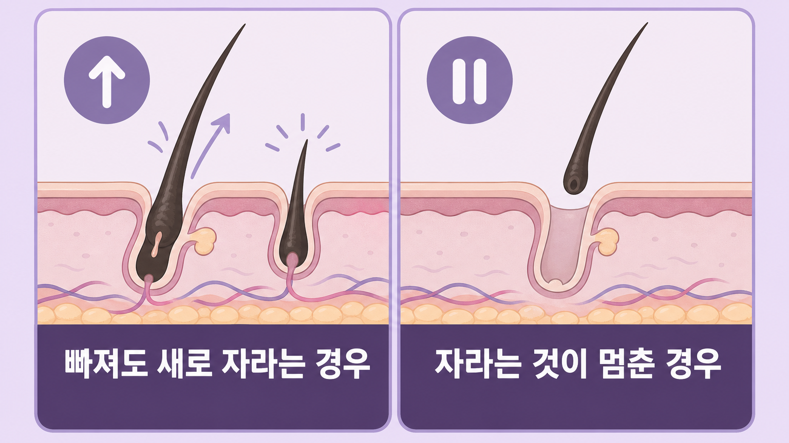 빠져도 새로 자라는 경우와 자라는 것이 멈춘 경우를 나란히 비교한 두피 단면 그림