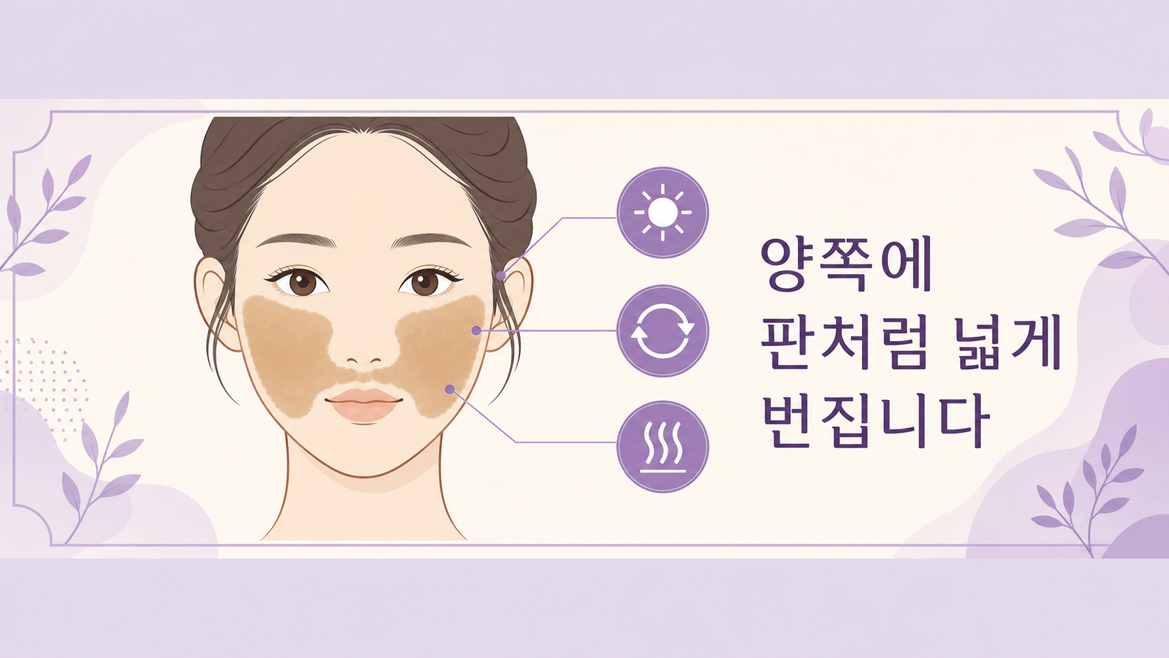 양쪽 뺨에 좌우 대칭으로 넓게 번진 판형 색소와 관여 요인을 표시한 도식
