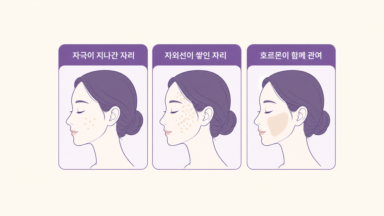 자극이 지나간 자리, 자외선이 쌓인 자리, 호르몬이 함께 관여하는 자리를 나란히 비교한 도식